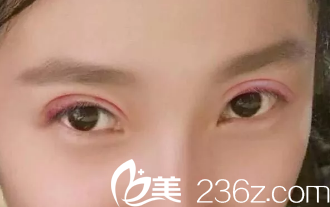 術(shù)后當(dāng)時(shí)的照片