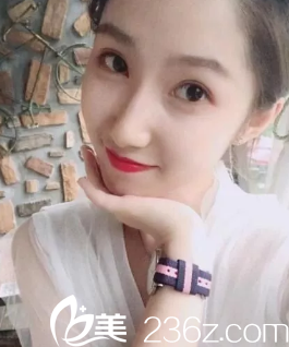 在煙臺(tái)美神做雙眼皮修復(fù)第60天