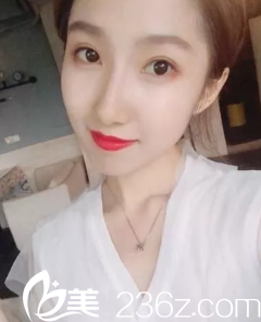 焦慮的去煙臺(tái)美神做了雙眼皮修復(fù)整形，我之前做過兩次雙眼皮手術(shù)