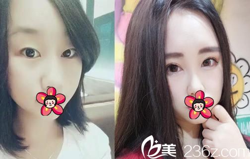 寧波北侖美仁洪江山雙眼皮開眼角案例