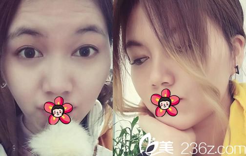 寧波美仁整形王英俊院長鼻綜合案例