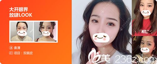 武漢美基元雙眼皮真人案例