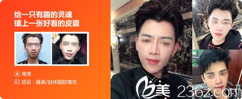 武漢美基元隆鼻+自體脂肪面部填充案例