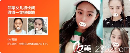 武漢美基元豐下巴真人案例