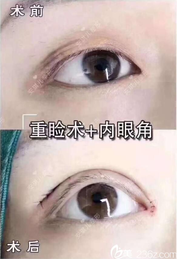 十堰安琪兒雙眼皮對比案例