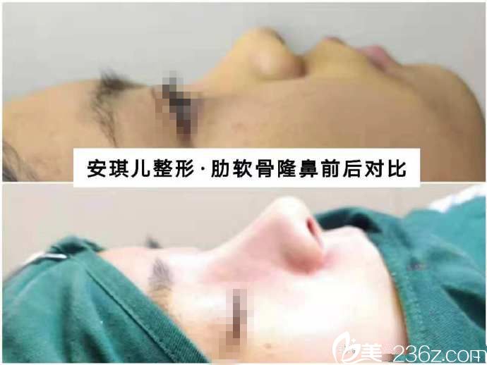 十堰安琪兒肋軟骨即刻效果對比