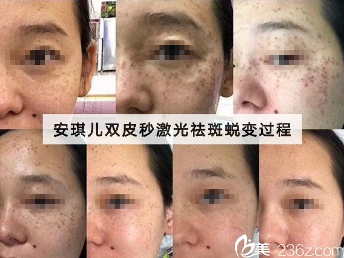 十堰安琪兒皮秒祛斑案例