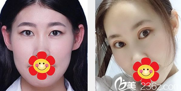 趙彥波醫(yī)生全切眼皮+全臉脂肪填充前后效果對(duì)比