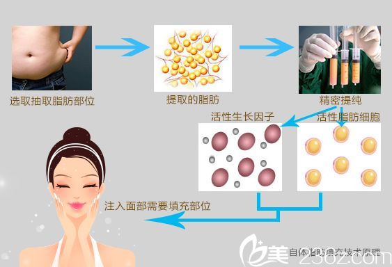 自體脂肪移植填充全過(guò)程