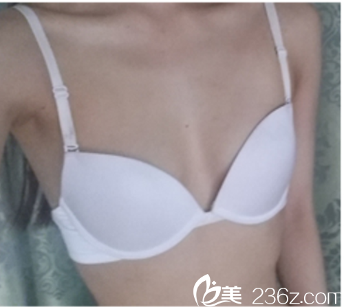 韓國麥恩醫(yī)院假體隆胸術(shù)前 韓國麥恩醫(yī)院假體隆胸術(shù)前