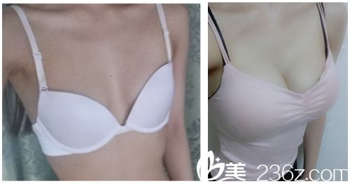韓國麥恩醫(yī)院假體隆胸對(duì)比圖 韓國麥恩醫(yī)院假體隆胸對(duì)比圖