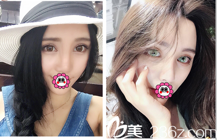 北京玲瓏梵宮肋軟骨隆鼻多少錢(qián)？自體肋軟骨隆鼻特惠價(jià)格表和案例來(lái)了解