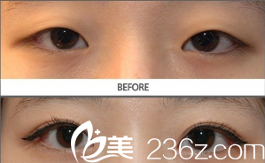 雙眼皮不對(duì)稱修復(fù)案例