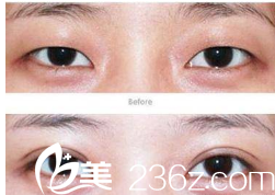 初次雙眼皮整形案例對(duì)比圖