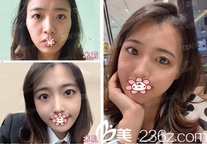 成都銅雀臺(tái)<!--<i data=20240703-sp></i>-->克拉雙心臉術(shù)后效果 成都銅雀臺(tái)<!--<i data=20240703-sp></i>-->克拉雙心臉術(shù)后效果