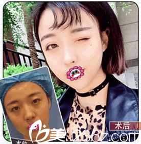 南京美貝爾黃名斗院長雙眼皮前后對比照