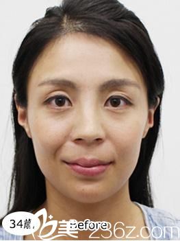 照屋智埋線提升前 照屋智埋線提升前