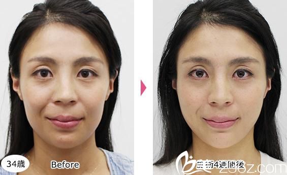 照屋智埋線提升前后對比 照屋智埋線提升前后對比