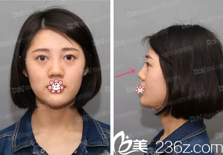 玻尿酸隆鼻術(shù)后正面?zhèn)让嬲掌? alt=