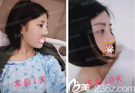 自體肋軟骨隆鼻墊鼻尖術(shù)后照片 自體肋軟骨隆鼻墊鼻尖術(shù)后照片