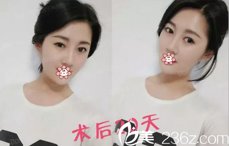 陶俊自體肋軟骨隆鼻術(shù)后20天 陶俊自體肋軟骨隆鼻術(shù)后20天