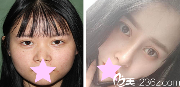 韓國本沐整形洪正秀醫(yī)生做鼻綜合+假體隆鼻效果案例