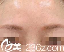 怎么消除川字紋--日本的品川美容外科的小池康弘醫(yī)生通過(guò)注射瘦臉除皺讓我愁眉舒展