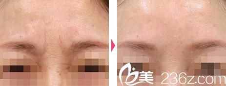 小池康弘瘦臉除皺祛皺前后對比 小池康弘瘦臉除皺祛皺前后對比