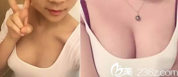 寧波建國整形馬越波自體脂肪隆胸<span style= 寧波建國整形馬越波自體脂肪隆胸<span style=
