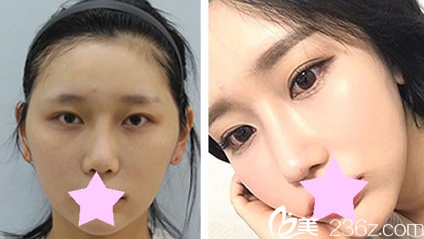 李芳碩醫(yī)生鼻綜合+耳軟骨隆鼻效果案例