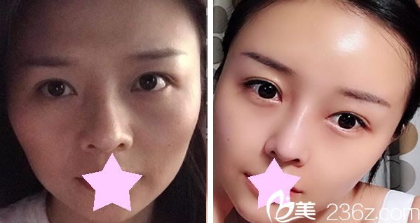 樸用南醫(yī)生做全臉脂肪填充效果案例