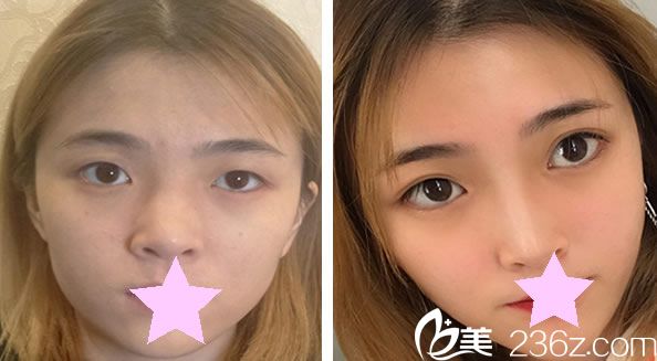 林兌根下頜角縮小術(shù)效果案例