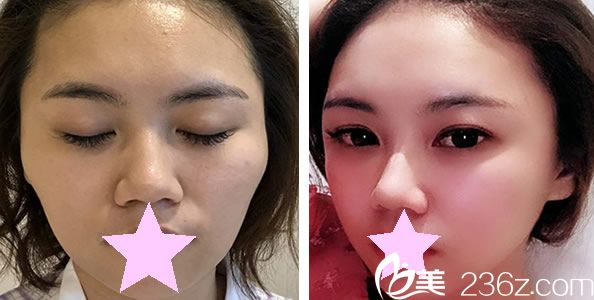 李秉烈醫(yī)生顴骨顴弓整形手術(shù)效果案例