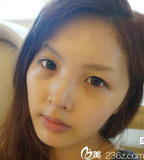 韓國麥恩醫(yī)院眼部埋線+鼻部+脂肪填充術(shù)前 韓國麥恩醫(yī)院眼部埋線+鼻部+脂肪填充術(shù)前