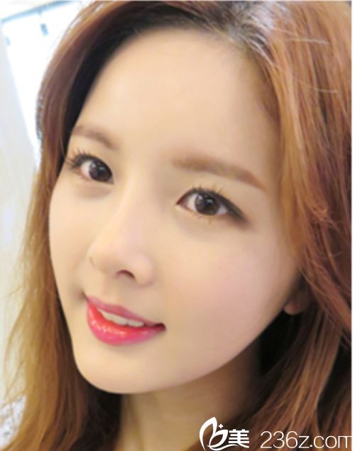 韓國麥恩醫(yī)院眼部埋線+鼻部+脂肪填充術(shù)后1個月 韓國麥恩醫(yī)院眼部埋線+鼻部+脂肪填充術(shù)后1個月