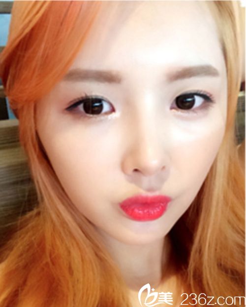 韓國麥恩醫(yī)院眼部埋線+鼻部+脂肪填充術(shù)后3個月 韓國麥恩醫(yī)院眼部埋線+鼻部+脂肪填充術(shù)后3個月