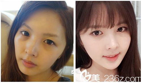 韓國麥恩醫(yī)院眼部埋線+鼻部+脂肪填充術(shù)前術(shù)后對比圖 韓國麥恩醫(yī)院眼部埋線+鼻部+脂肪填充術(shù)前術(shù)后對比圖