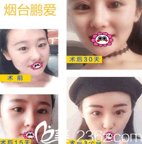 我在煙臺鵬愛整形醫(yī)院找魏璐做雙眼皮對比圖