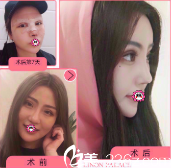 北京玲瓏梵宮生態(tài)隆鼻多少錢(qián)？生態(tài)隆鼻4980元起王光輝黃海濱坐診