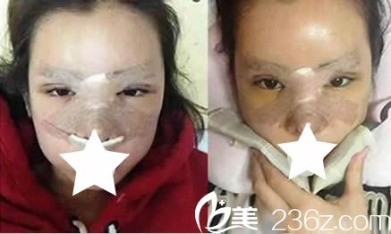 韓國青春整形雙眼皮+鼻綜合術(shù)后4天照 韓國青春整形雙眼皮+鼻綜合術(shù)后4天照