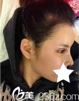 我在韓國青春整形做雙眼皮+隆鼻術(shù)后10天圖 我在韓國青春整形做雙眼皮+隆鼻術(shù)后10天圖