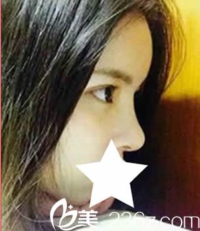 聽說韓國青春整形外科比較有名，我就讓姜畫神院長做鼻綜合隆鼻和雙眼皮