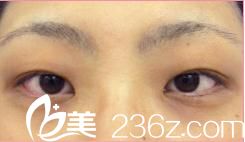 森上和樹雙眼皮手術(shù)前 森上和樹雙眼皮手術(shù)前