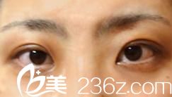 去日本城本整形外科醫(yī)院找森上和樹醫(yī)生為我做了切開雙眼皮，丑小鴨成了白天鵝!