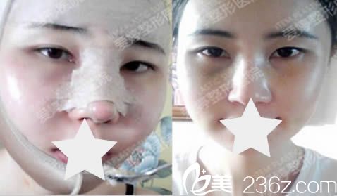 韓國愛婷整形隆鼻+磨顴骨術(shù)后照