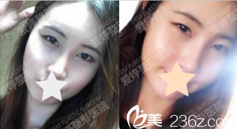 韓國愛婷整形磨顴骨和面部脂肪填充術(shù)后圖