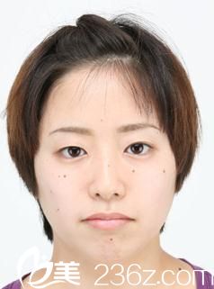 森上和樹注射玻尿酸墊下巴前 森上和樹注射玻尿酸墊下巴前