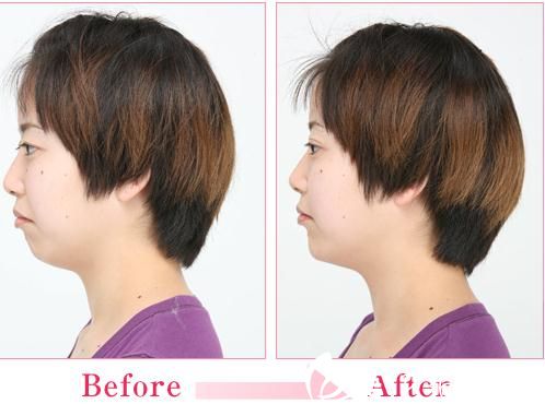 森上和樹注射玻尿酸墊下巴前后對(duì)比照 森上和樹注射玻尿酸墊下巴前后對(duì)比照