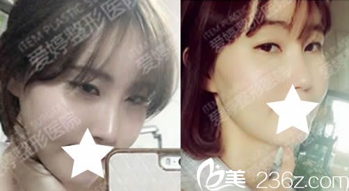 在韓國(guó)愛婷看了金振星院長(zhǎng)的面部輪廓整形案例后 找他做了隆鼻和磨顴骨及面部脂肪填充