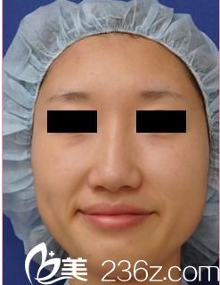 田中真輔隆鼻手術(shù)前 田中真輔隆鼻手術(shù)前